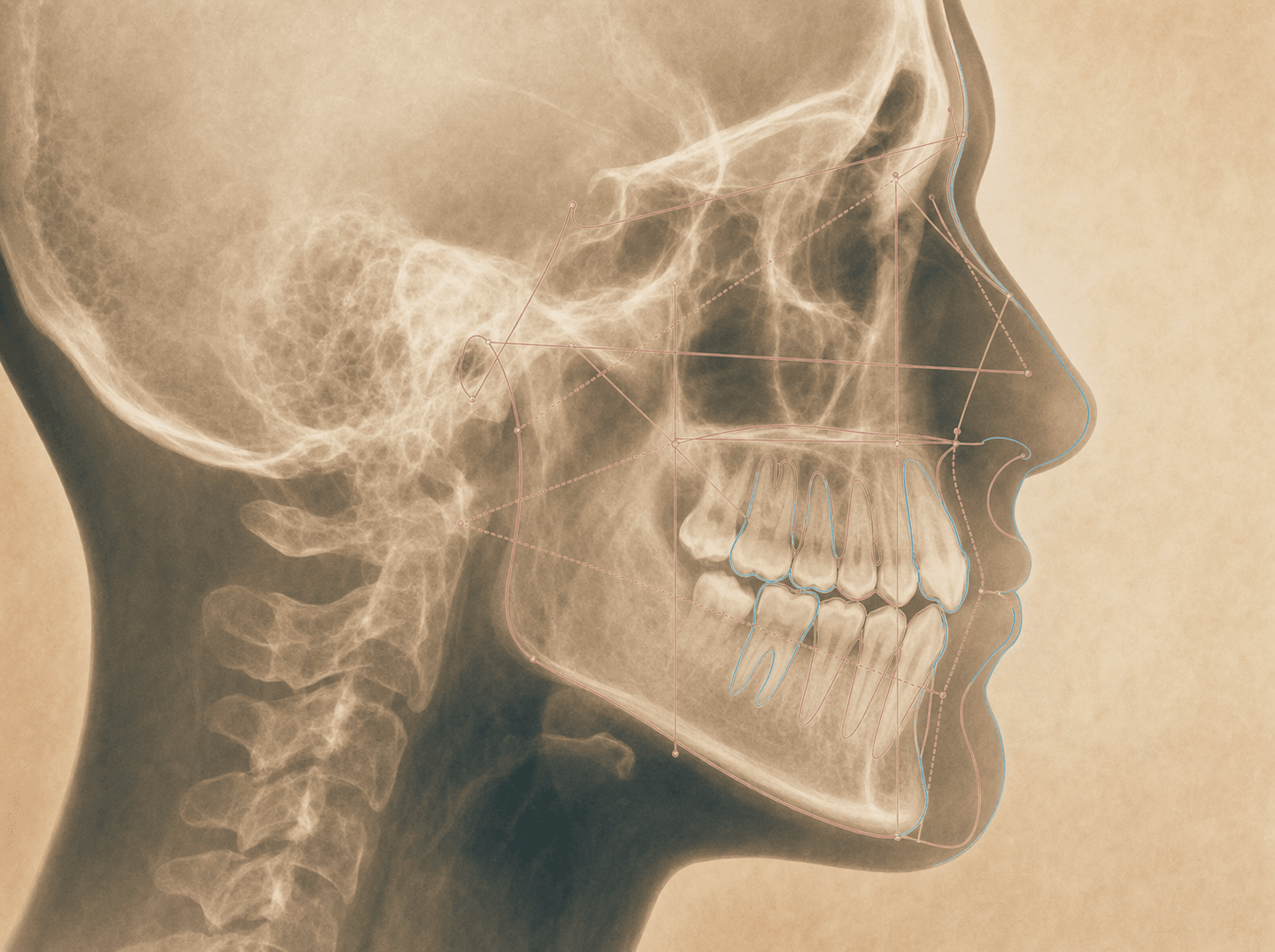 A lateral cephalometric radiograph of a skull in profile with orthodontic tracing lines drawn over the jaws and teeth (2D cephalometric image for orthodontic measurement), warm muted tones
