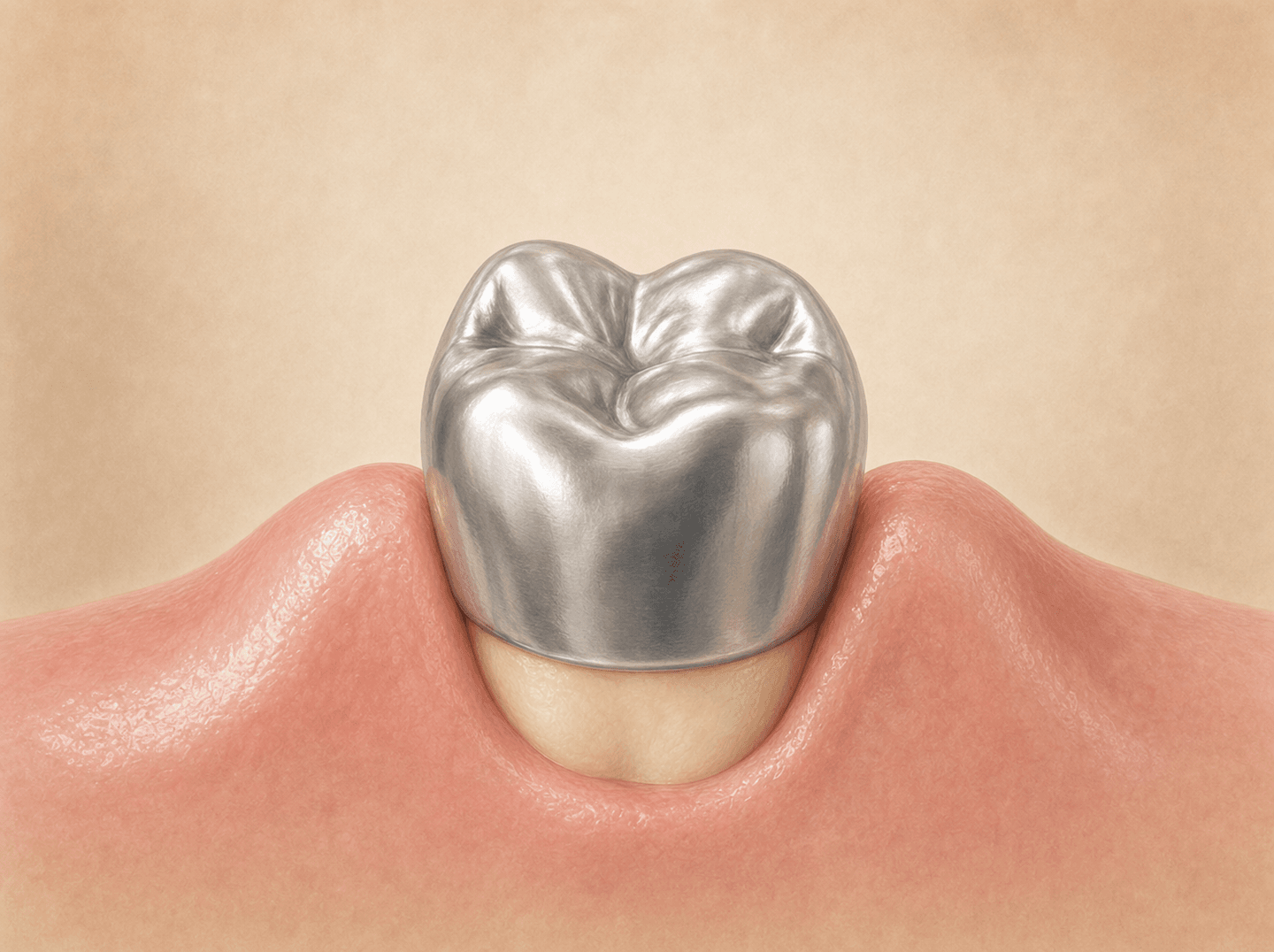 Editorial illustration of a silver metal cap seated over a small back baby tooth (prefabricated stainless steel crown on a primary molar), warm muted tones