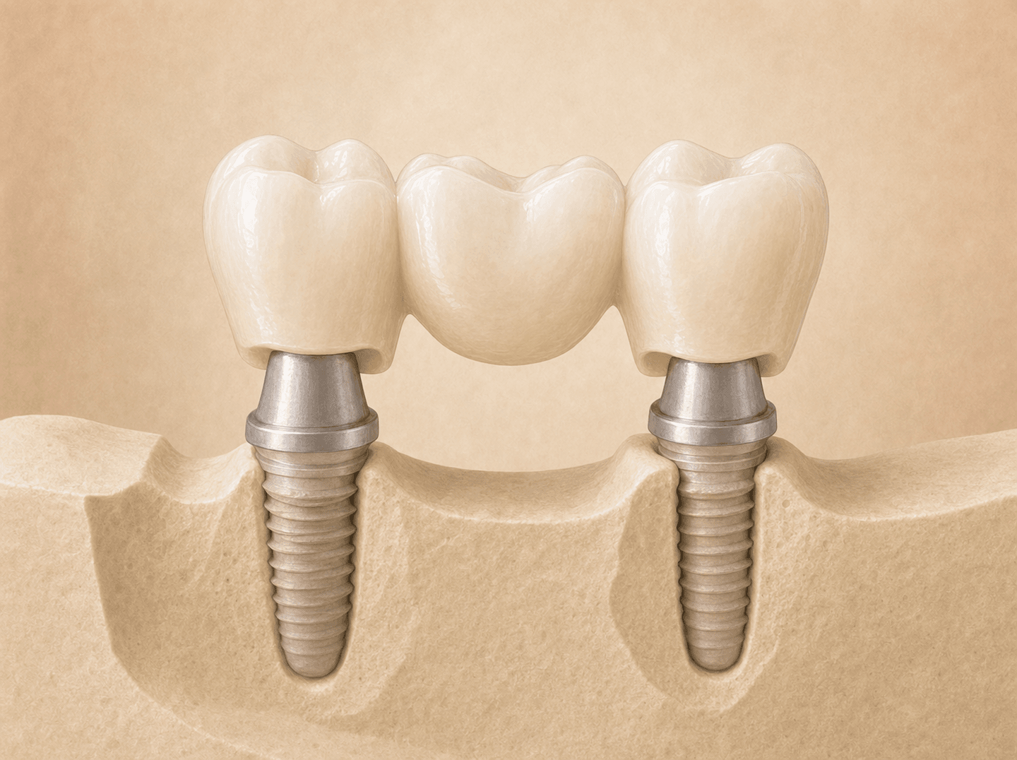 Editorial illustration of two all-ceramic retainer crowns seated on separate implant abutments with a ceramic pontic suspended between them on a study model (abutment-supported porcelain/ceramic fixed partial denture retainers), warm muted tones