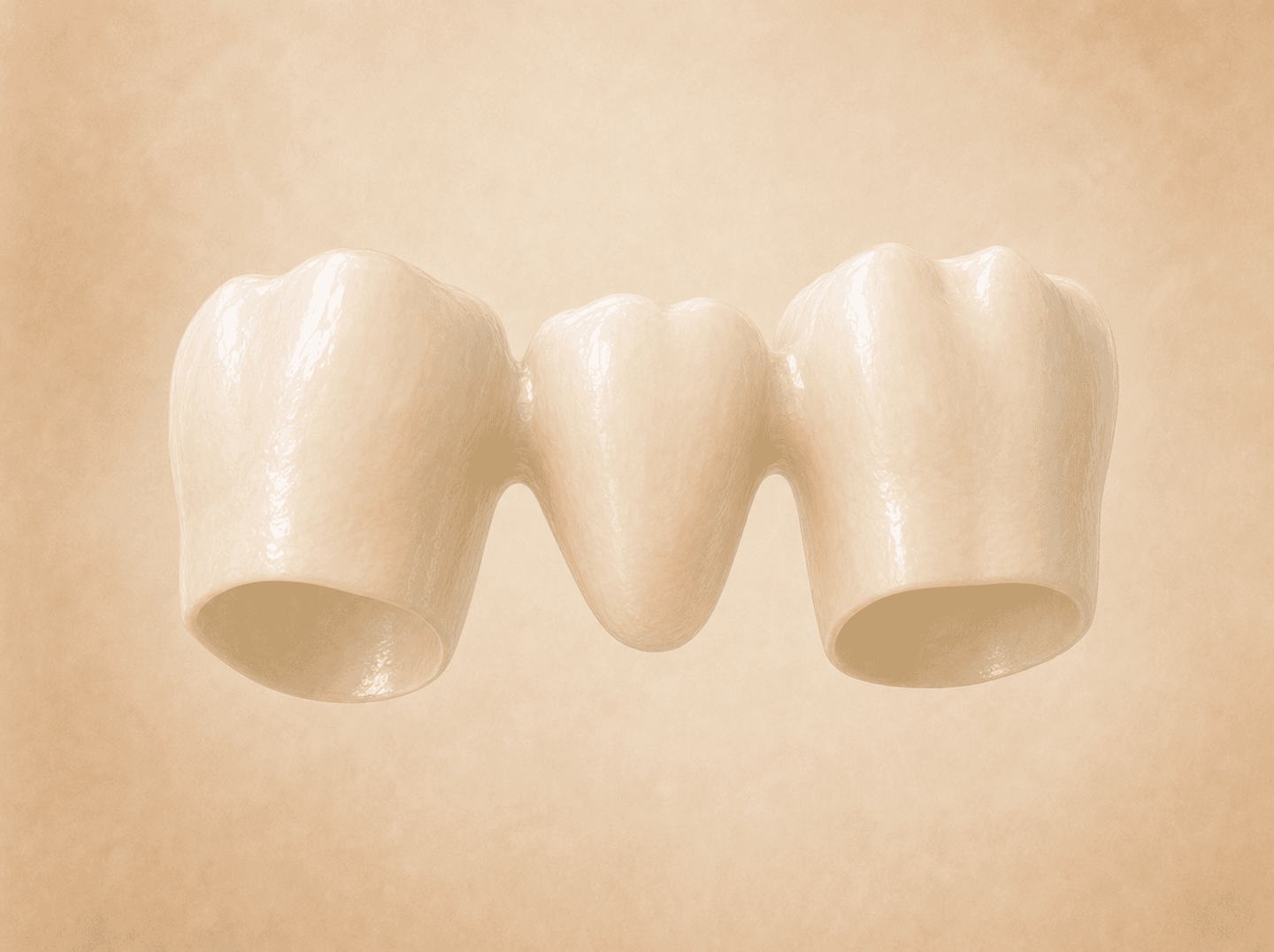 Editorial illustration of a three-unit bridge with a white all-ceramic replacement tooth suspended between two retainer crowns (porcelain/ceramic pontic), warm muted tones