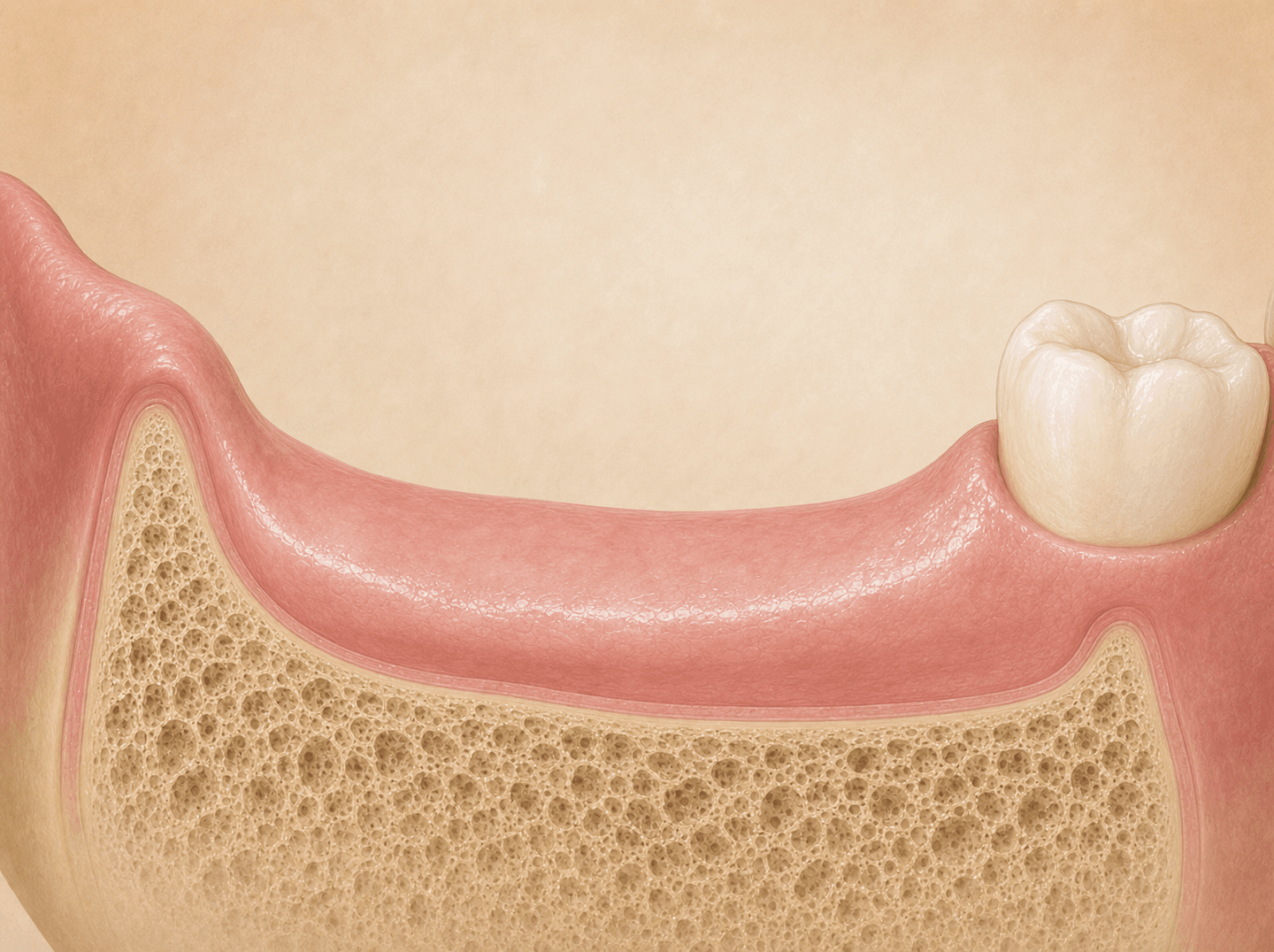 Editorial illustration of a smoothed dental ridge after multiple extractions in one quadrant (alveoloplasty), warm muted tones
